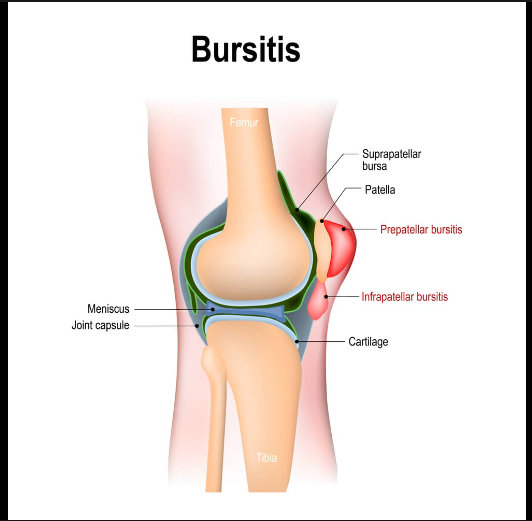 Bursitis