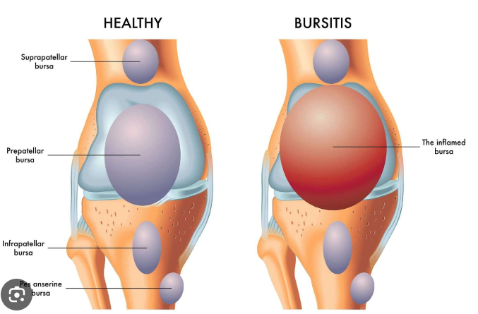 bursitis