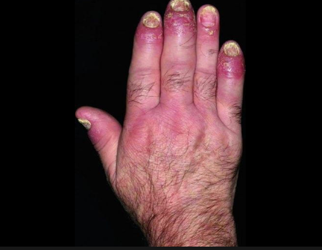 Psoriatic Arthritis