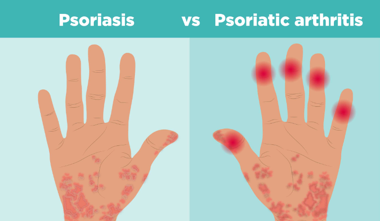 Psoriatic Arthritis