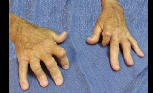 Psoriatic Arthritis