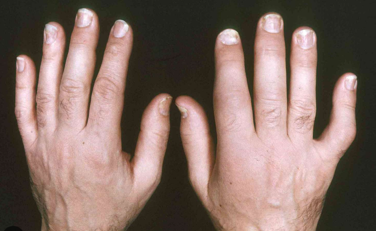 Psoriatic Arthritis