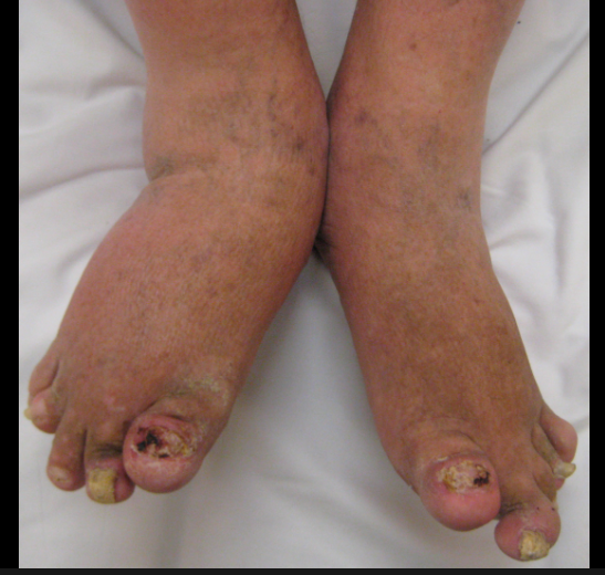 Psoriatic Arthritis