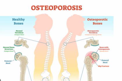 osteoporosis