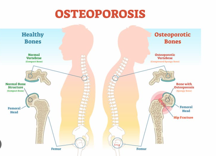 India has six crore osteoporosis patients 