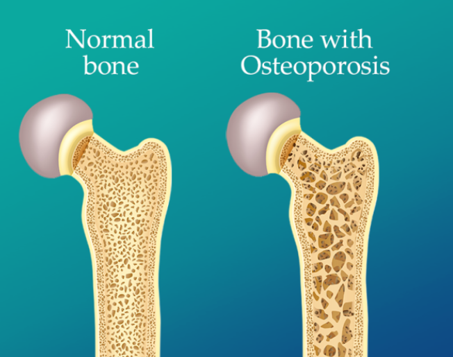 Osteoporosis