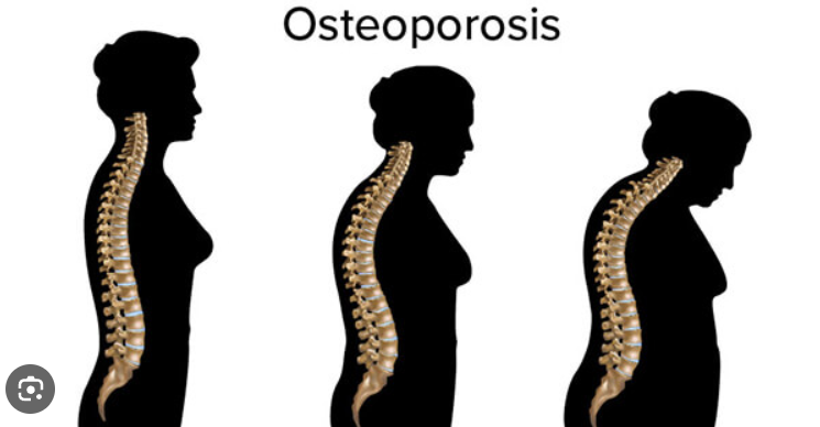 Osteoporosis