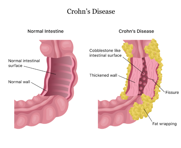 Scoliosis