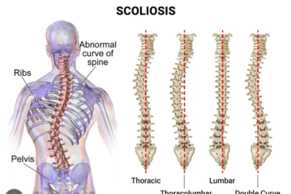 Scoliosis