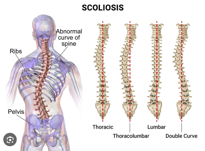 Scoliosis