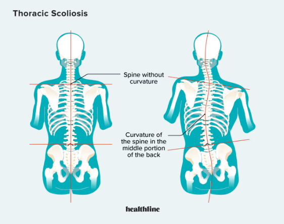 Scoliosis