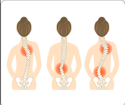 Scoliosis