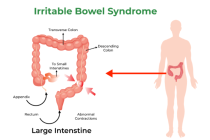 Irritable Bowel Syndrome