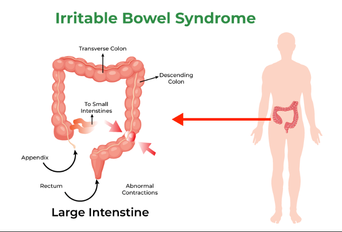 Irritable Bowel Syndrome