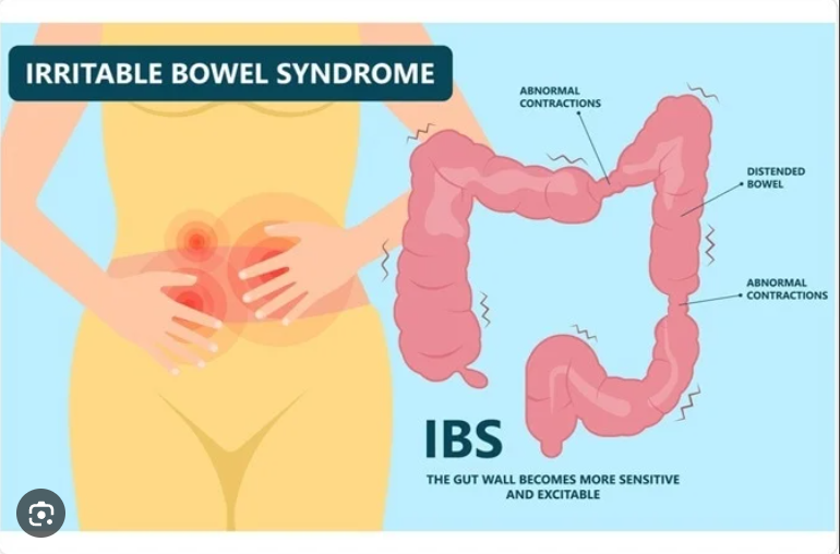 Irritable Bowel Syndrome 