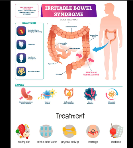 Irritable Bowel Syndrome 