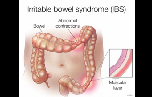 Irritable Bowel Syndrome 