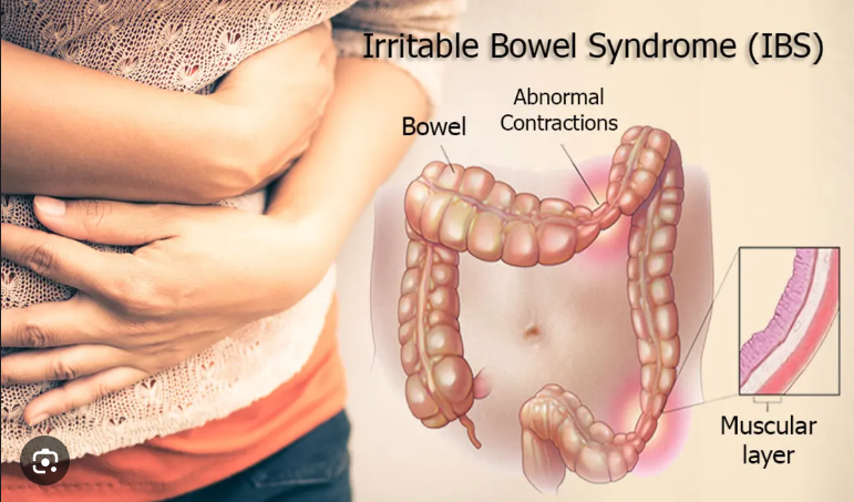 Irritable Bowel Syndrome 