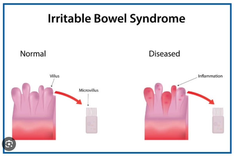 Irritable Bowel Syndrome 