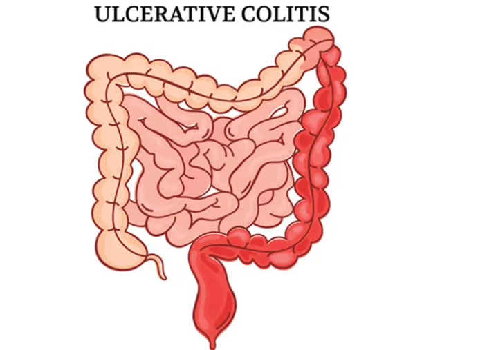 Ulcerative Colitis