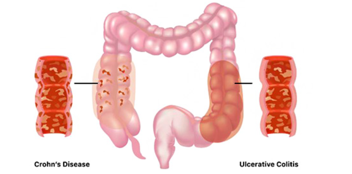 ulcerative colitis