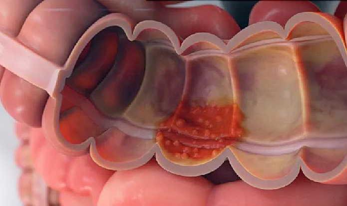 ulcerative colitis