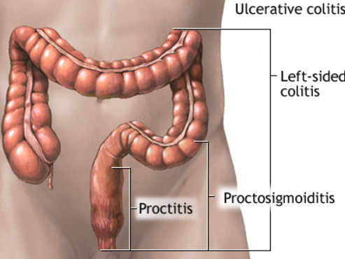 ulcerative colitis