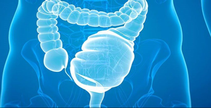 ulcerative colitis