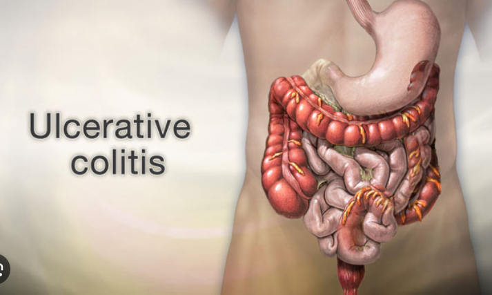 ulcerative colitis