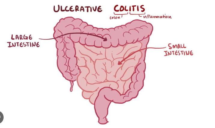 ulcerative colitis