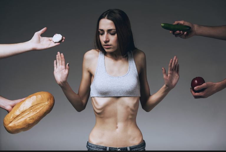 Anorexia Nervosa 