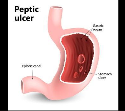 Peptic Ulcers