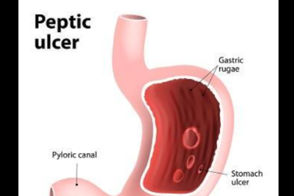 Peptic Ulcers