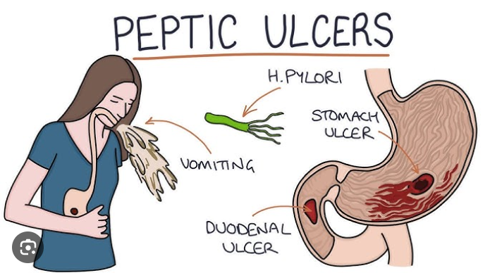 Peptic Ulcers