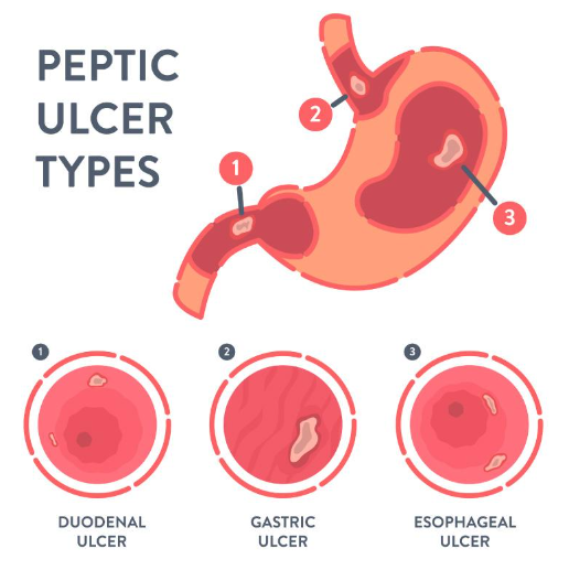 Peptic Ulcers