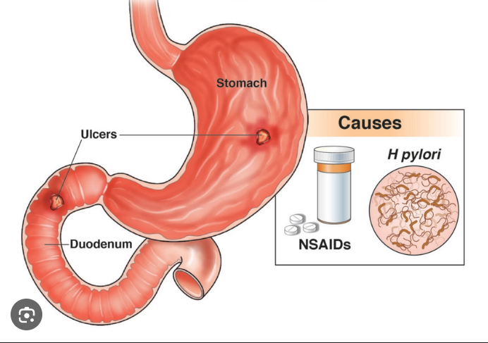 Peptic Ulcers