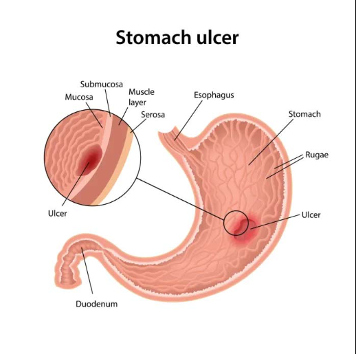 Peptic Ulcers