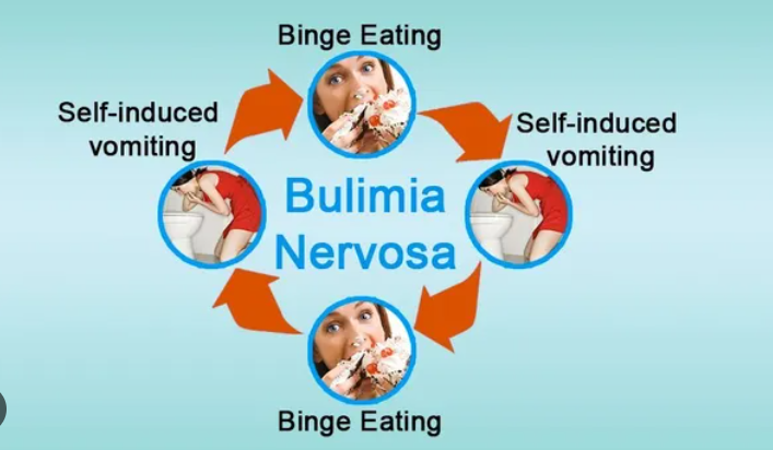 Bulimia Nervosa