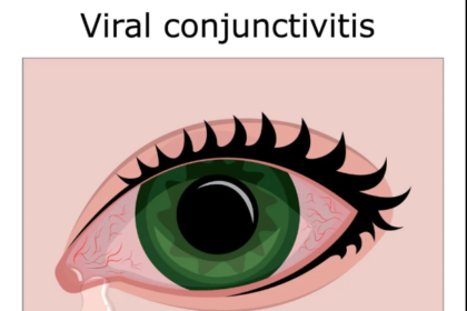 Conjunctivitis