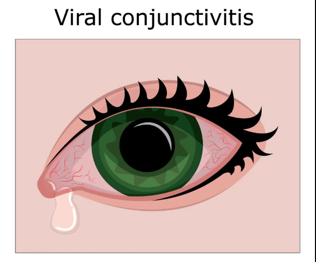 Conjunctivitis