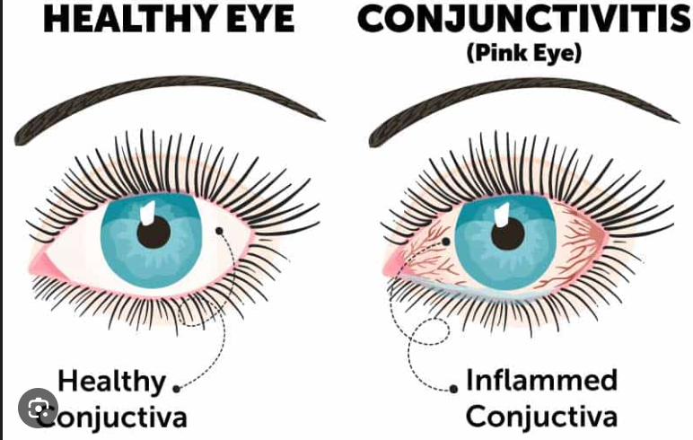 Conjunctivitis