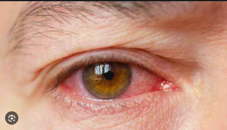 Conjunctivitis