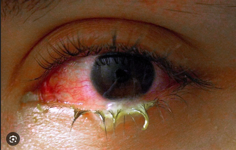 Conjunctivitis