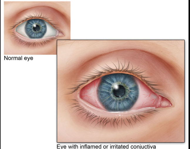 Conjunctivitis