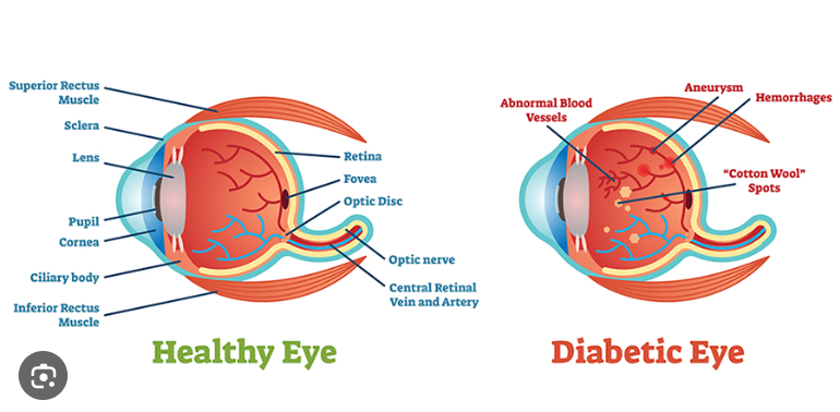 eye disease