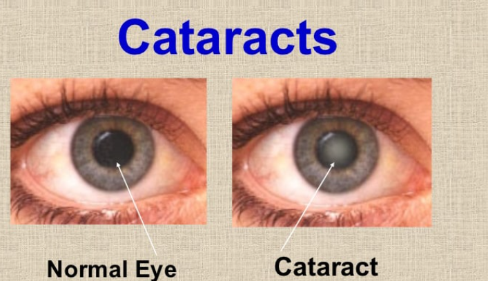 Cataracts