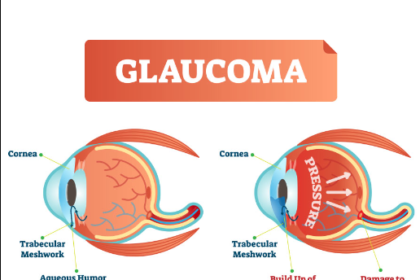 glaucoma