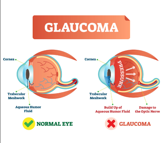 glaucoma