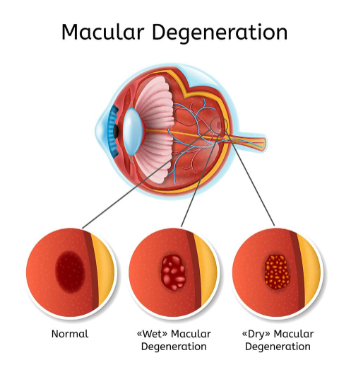 Macular degeneration