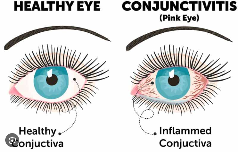 Conjunctivitis